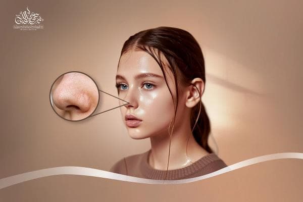 طرق علاج الرؤوس السوداء